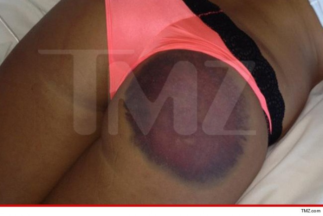 03-14-14-playmate-butt-bruise-tmz-3