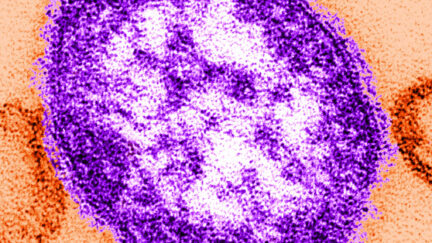 Measles